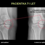 Trápí vás artróza kloubů? Jistě vás bude zajímat její léčba pomocí kmenových buněk.