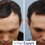 Účinnou metodou v boji proti vypadávání vlasů a alopecii je transplantace