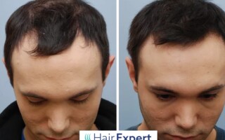 Účinnou metodou v boji proti vypadávání vlasů a alopecii je transplantace Účinnou metodou v boji proti vypadávání vlasů a alopecii je transplantace